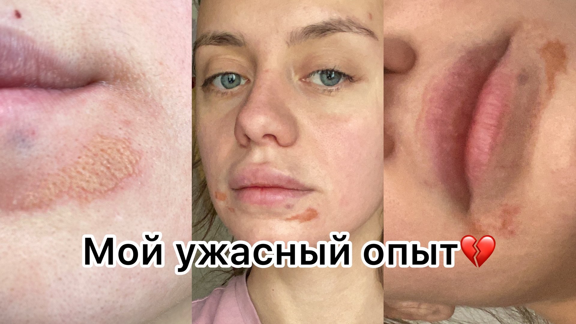 УВЕЛИЧЕНИЕ ГУБ. МОЙ УЖАСНЫЙ ОПЫТ. ВСЯ ПРАВДА. смотреть онлайн