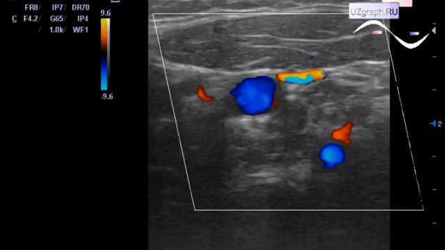 Детская УЗДГ (допплерография) магистральных сосудов шеи - Гипоплазия позвоночной артерии у подростк смотреть онлайн