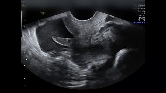 Разрыв кисты смотреть онлайн