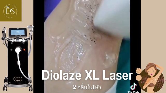มากำจัดขนด้วยเลเซอร์2พลัง (DIOLAZE XL LASER (2คลื่นใน1หัว) смотреть онлайн