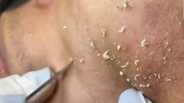 Remoção De Cravo 2021 - Pimple Popping 2021- Blackhead Removal 0016