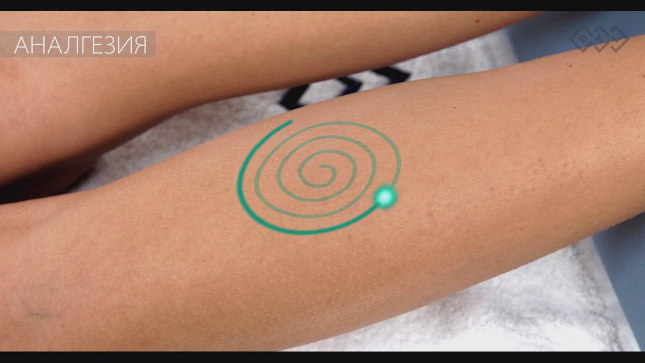 Триггерные точки. Терапевтическое видео: лазер высокой интенсивности BTL-6000 HIL. смотреть онлайн