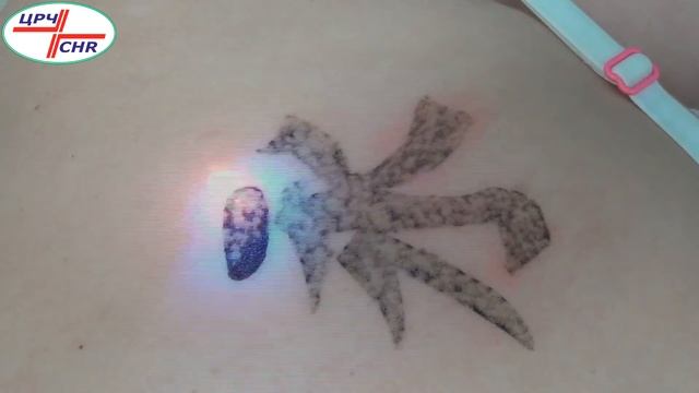 Удаление татуировки лазером смотреть онлайн