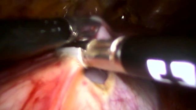 лапароскопическая резекция кисты почки смотреть онлайн