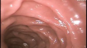 ФГДС / Фиброгастродуоденоскопия / gastroscopy procedure