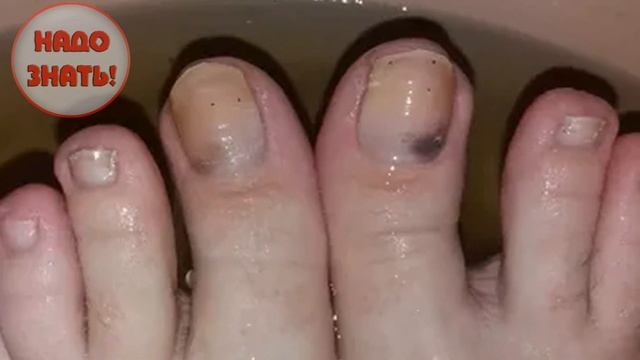 Как и почему чернеют ногти на ногах?