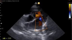 Недостаточность митрального клапана ЭХОКГ