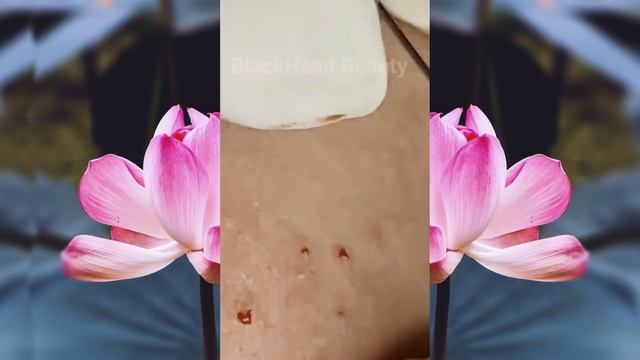 Выдавливание чёрных точек НОВОЕ! Удаление чёрных точек за ухом. p15 смотреть онлайн