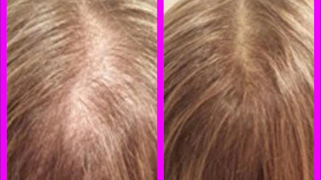 Волосы после этого масла растут с БЕШЕНОЙ скоростью. смотреть онлайн