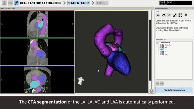 Automatic Artificial Intelligence based segmentation смотреть онлайн