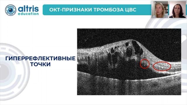 Нарушения кровообращения в системе центральной вены сетчатки: особенности визуализации на ОКТ смотреть онлайн