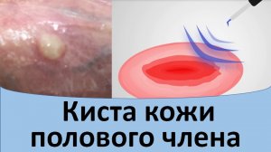 Киста кожи полового члена