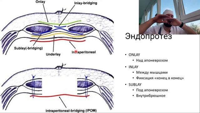 Современные виды герниопластики. TAPP/TEP. Сетчатый эндопротез. Сетка смотреть онлайн