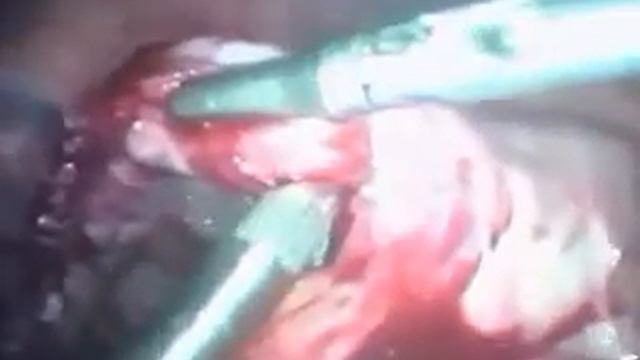 Лапароскопическая аппендэктомия 3 часть 2 русский смотреть онлайн