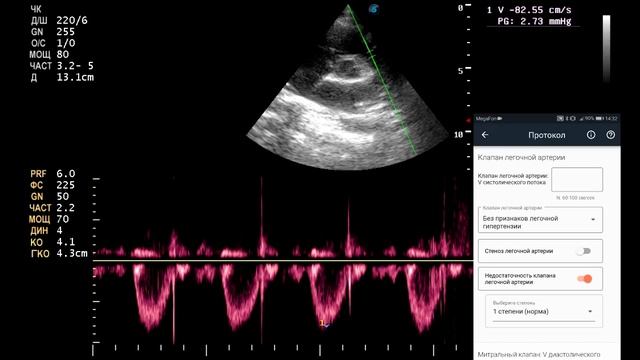 Методика эхокардиографии для начинающих смотреть онлайн