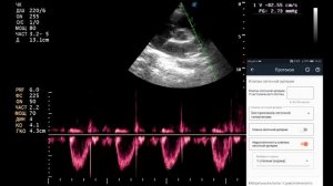 Методика эхокардиографии для начинающих