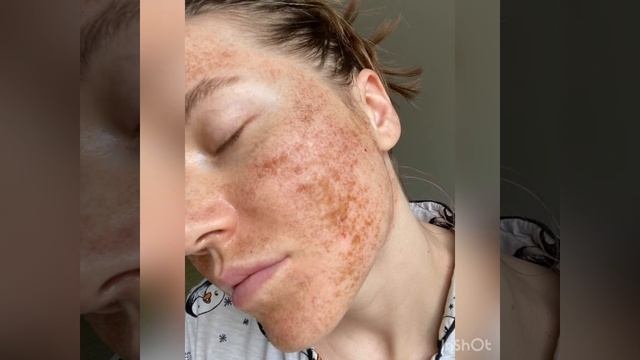 Что происходит с лицом После лазерной Шлифовки По Дням смотреть онлайн