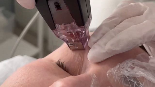 Микроигольчатый RF лифтинг InMode Morpheus 8 смотреть онлайн