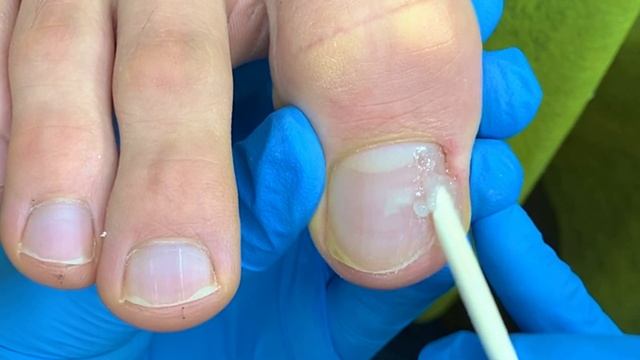 Оторвал ноготь и не заметил ??♀️, исправляем Nagelmasse от Pedibaehr смотреть онлайн