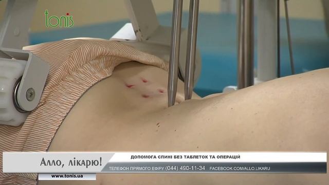 Алло, доктор! Межпозвоночная грыжа смотреть онлайн