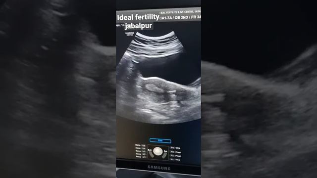 Embryo Transfer under ultrasound guide #ideal_fertility #the_story_tour смотреть онлайн
