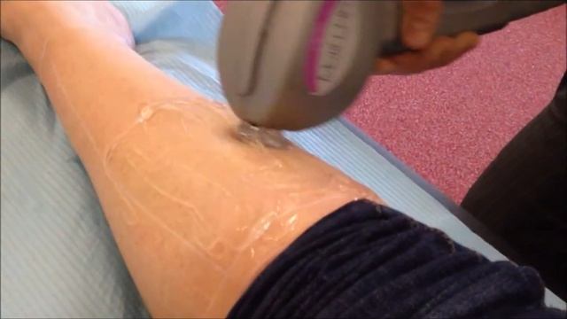 Лазерная элос эпиляция - eLase Motif от Syneron смотреть онлайн