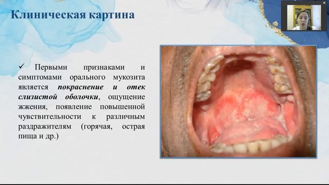 Оральный мукозит смотреть онлайн