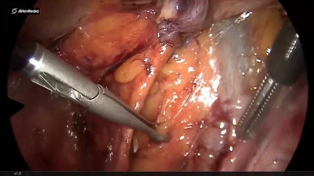Pelvic lymph node dissection in gynecologic cancer смотреть онлайн