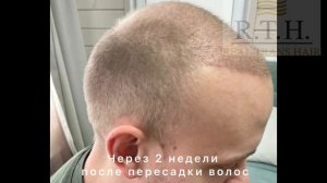 ДО и через год после пересадки волос☀️