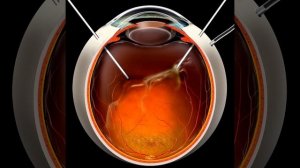Витрэктомия - лечение отслойки сетчатки глаза