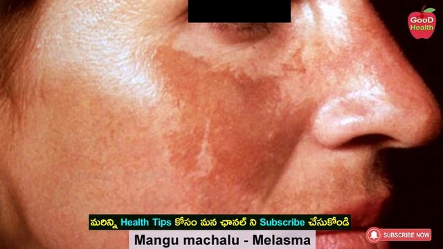 How to Remove DARK SPOTS, BLACK SPOTS | Mangu Machalu | Dr Manthena Satyanarayana Raju Videos смотреть онлайн