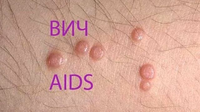 Первые симптомы ВИЧ смотреть онлайн