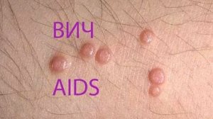 Первые симптомы ВИЧ