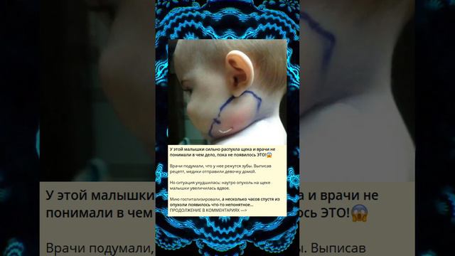 У этой малышки сильно распухла щека и врачи не понимали в чем дело, пока не появилось ЭТО!😱 смотреть онлайн