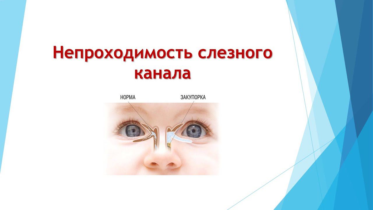 Непроходимость СЛЕЗНОГО КАНАЛА смотреть онлайн