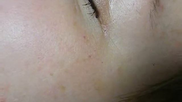 Удаление сосудистых точек смотреть онлайн