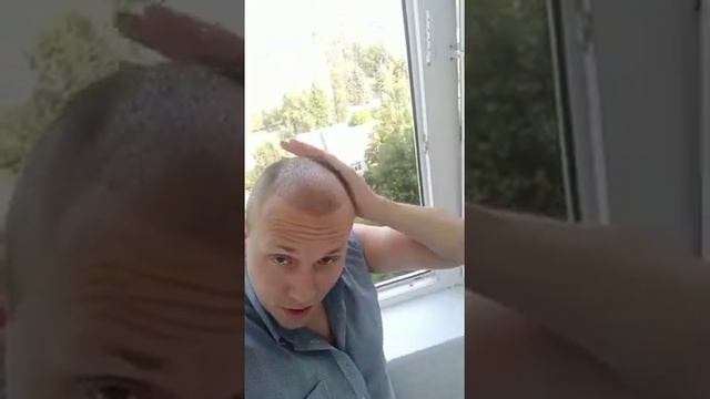 10 дней после пересадки волос в Bellus clinic смотреть онлайн