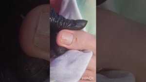 Прострел на ногте.Вросший ноготь.Разрузка бокового валика.Разгрузка ТеМПО. Зачистка ногтя