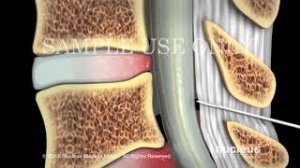 Эпидуральная блокада - введение стеройдов.