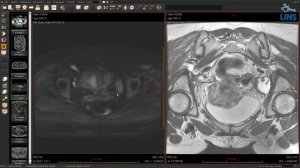 МРТ малого таза - наши ошибки. Ирина Трофименко