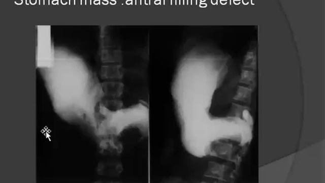 2017 07 16 GIT 6 Gastric masses смотреть онлайн
