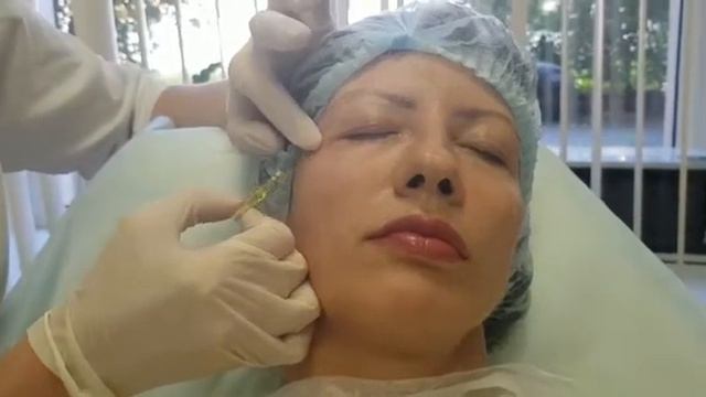 Нитевой лифтинг периорбитальной зоны в салоне "Orlova Beauty". Часть 3 смотреть онлайн