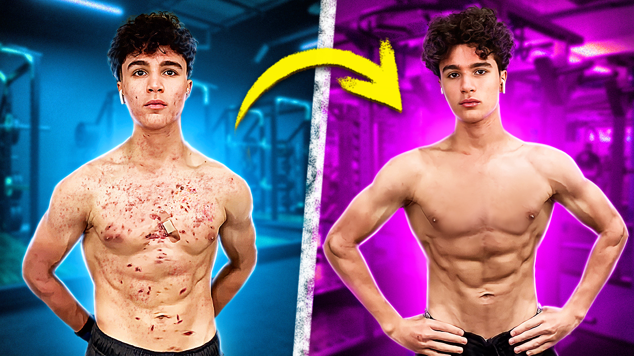 САМАЯ ГЛАВНАЯ ПРИЧИНА, почему лезут прыщи / АКНЕ НА СТЕРОИДАХ смотреть онлайн