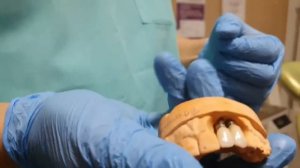 ЦИРКОНИЕВЫЕ КОРОНКИ НА ИНДИВИДУАЛЬНОМ ЦИРКОНИЕВОМ АБАТМЕНТЕ