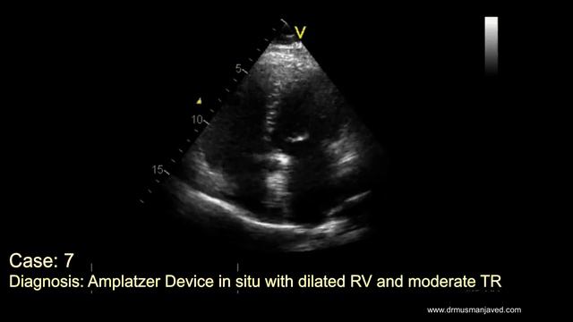 Case 7: Echocardiography Spot Diagnosis Case Series #echocardiography #echo #cardiology смотреть онлайн