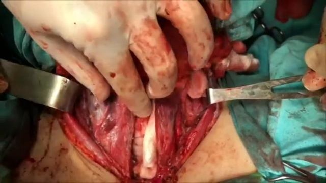 Prof. Aziz Aliyev Thyroid With Lymph Node Dissection смотреть онлайн