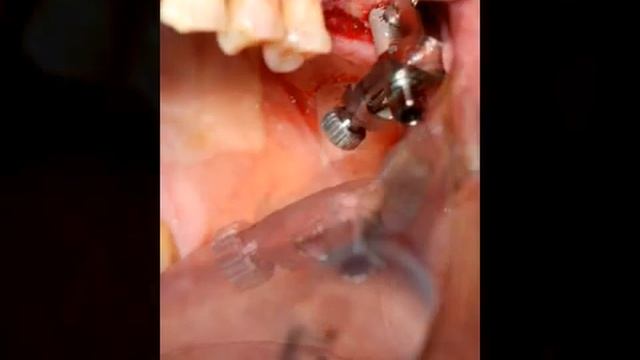 Sinus Lift Implant смотреть онлайн