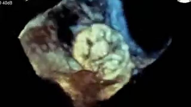 Ultrasept 30mm PFO 3-D Image #2 смотреть онлайн