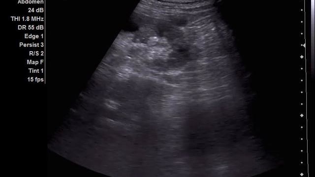 Left Kidney And Lymphatic Node