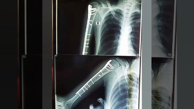PHILOS plate for Fracture Shaft of Humerus смотреть онлайн